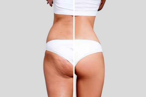 Cryo-Cellulite Package